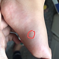 宝妈们帮我看下是不是手足口 ，吓死我了……急