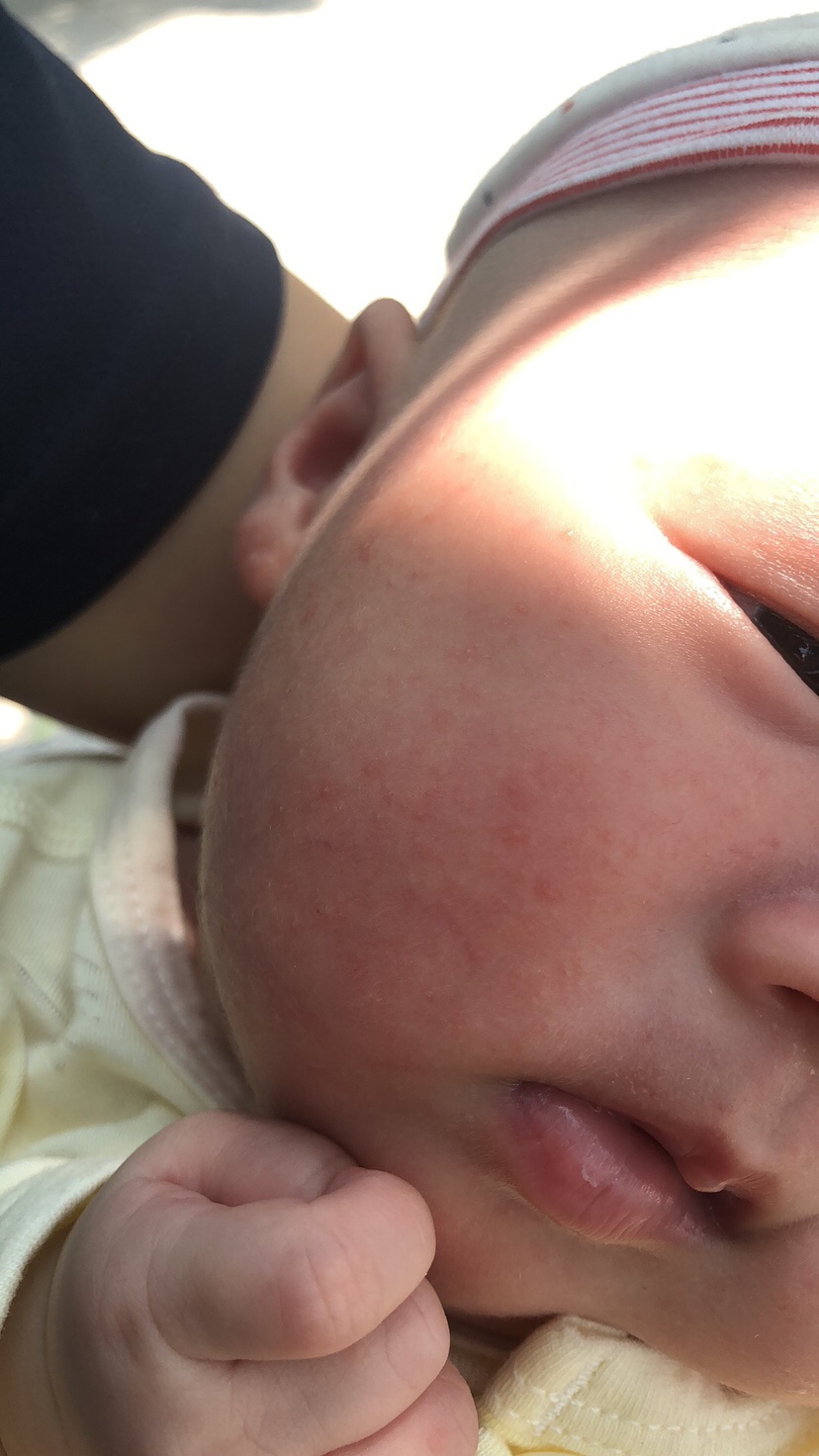 这是什么？火气还是？有宝妈知道吗？