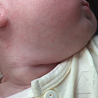 这是什么？火气还是？有宝妈知道吗？