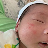 请问这是痱子吗，去母婴店洗澡说这是痱子，用什么药好