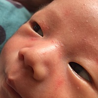 各位宝妈们麻烦帮忙看看宝宝脸上长的是啥