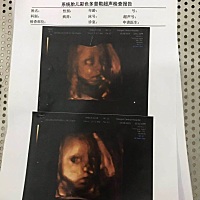 6月18号，剖腹产，生下7斤的小公主。刨的时候没感觉，刨完第二天疼得哭。那过程我就不细说了啊。 头...