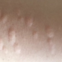 荨麻疹，出月子后长了一个星期，好了，后来估计变慢性的了，天天晚上就开始长点，现在又开始严重了，烦...