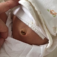 宝妈们，出现这种情况的怎么处理，肚脐带没有全掉干净，还很干，今天已经第九天了
