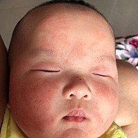 来谈一下我宝宝和湿疹的斗争经历。宝宝出生时在江西 一个月的时候就有湿疹了 渗出性的 会流水那种 但脸...