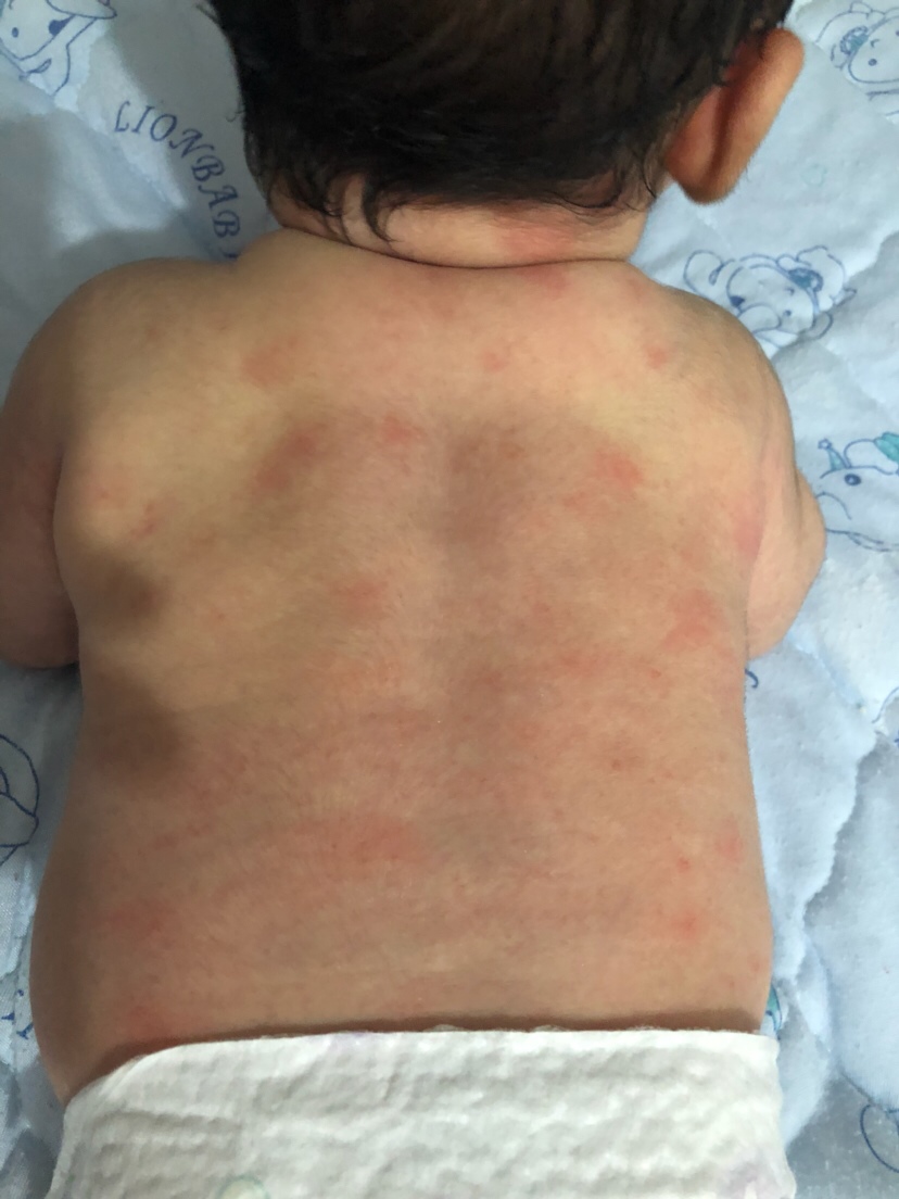 刚洗澡发现宝宝后背这样大家知道怎么回事吗？宝宝一个月零六天