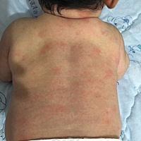 刚洗澡发现宝宝后背这样大家知道怎么回事吗？宝宝一个月零六天