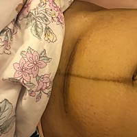 剖腹产第8天，