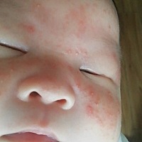 宝宝出生19天了，脸上长了这个苞，问医生，医生说没事，好几天了，还没好，想问下大家这怎么回事，