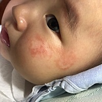 一个破湿疹，搞了差不多一个月！用了婴百舒，四五天就好了。谢天谢地