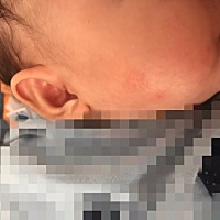 各位宝妈，麻烦帮忙看看这是不是湿疹，两脸上慢慢发出来的，下巴也抹着有像颗粒的感觉，宝宝两个月了算过敏