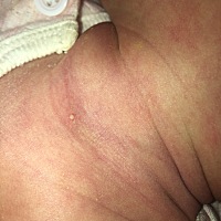 今天发现宝宝脖子上长了个这！不知道是普通的白泡还是什么？刚当妈妈有点玻璃心