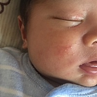 21天的宝宝脸上起了红色的小颗粒物，有经验的宝妈帮我看看是热疹还是上火了