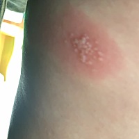 大神请指教，这是什么，全是小水泡。