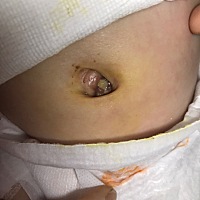 宝宝今天脐带不小心被蹭掉了，这样的情况严重吗，求助各位宝妈