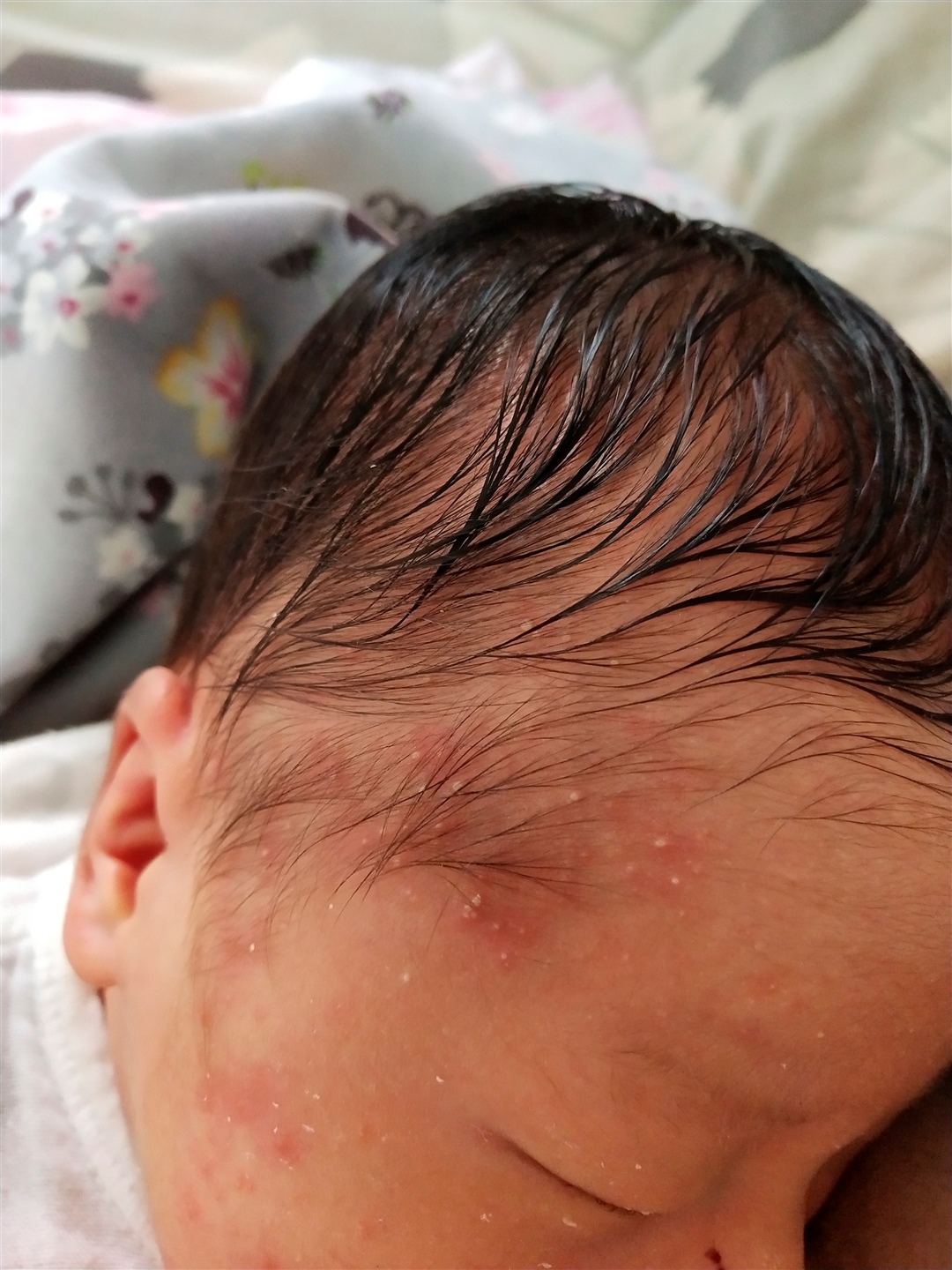 宝宝20天，冒出像白头一样的红点点，有知道是什么疹的吗？