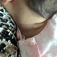 宝宝脖子有好几个圆形凸起，天热发红，天凉快就是皮肤色。这是湿疹吗？