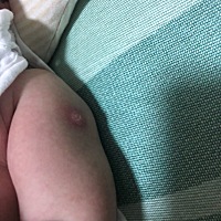 宝宝出生的时候打的疫苗 医生说有红肿硬块 但是现在42天了还没下去  正常吗