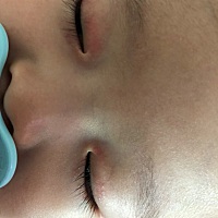 宝妈们，我想咨询一下宝宝总是揉眼睛，一柔整个眼睛外围就马上红红，还带一粒一粒，这是什么情况啊