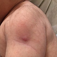 有没有谁知道出生后打预防针出现这种情况是什么原因？