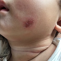 本来是湿疹 也抹了医生开的湿疹膏 几周了也没好 一直蹭成这样 该怎么办