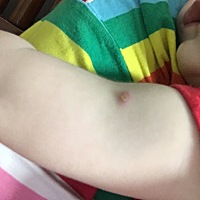 洗澡的时候不小心擦到了，看起来好像有脓