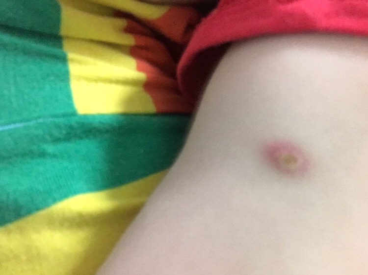 洗澡的时候不小心擦到了，看起来好像有脓