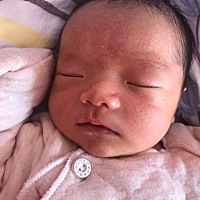 额头上的压痕医生说是剖宫产宫腔压迫，有宝宝有这样的吗？什么时候能消呢