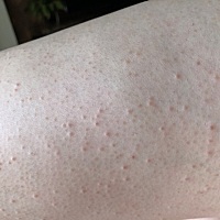 有没有宝妈生完宝宝大腿起小疙瘩的？出了月子开始起的，因为哺乳期吃药对宝宝不好，能不吃就最好不吃，...