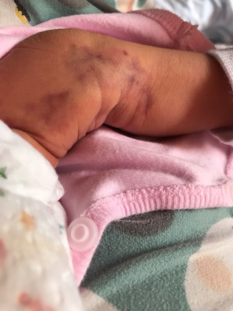 各位宝妈们，请教大家一个问题，你们有没有遇到过这种情况，宝宝出生后腿上有一处比较大的红斑，医生说让先观察，有点担心。麻烦各位遇到过同样情况的说说你们的结果。谢谢了🙏