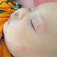 明明两个月的时候已经没湿疹了，最近又陆续来了，而且之前百试百灵的面霜膏不起作用了，晚上看他一直挠...