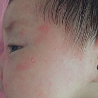 宝宝脸上起了这样的痘痘，是上火还是湿疹？可以擦药么？