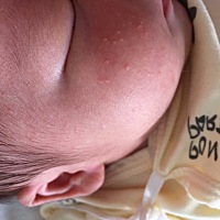 这个脸上疙瘩是湿疹吗？莫名其妙有这个，求赐教。。。。