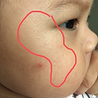 有没有宝妈知道这脸上长得一粒粒的是什么？两个月的时候就长了 现在三个月了还没消