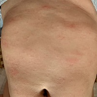 各位宝妈，宝宝肚子上这是什么啊，是天热的痱子嘛