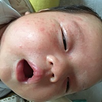 我可怜的宝宝才出生25天就长了这么多痱子，看着都心疼，也都怪为娘的没照顾好你，对不起😭😭