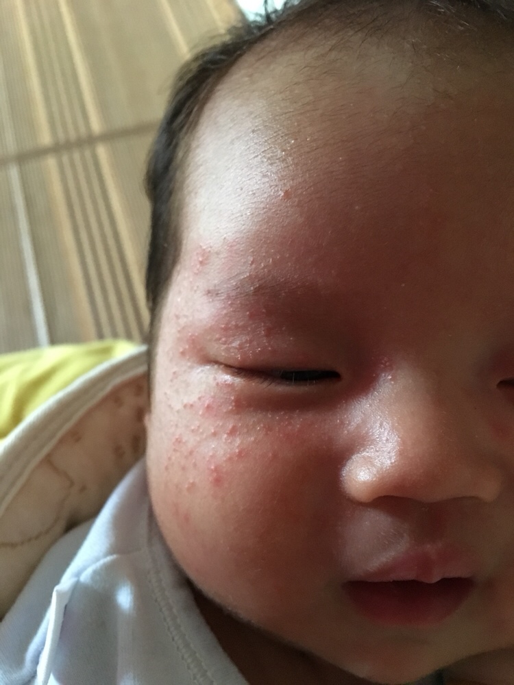 我可怜的宝宝才出生25天就长了这么多痱子，看着都心疼，也都怪为娘的没照顾好你，对不起😭😭