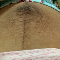 我想问下生过娃的宝妈们，肚子变成这样能修复吗，好丑，黑色素好严重。