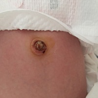 宝妈们，有没有家里宝宝脐带掉了有我家这种情况的，这个脐窝里黄乎乎的是啥～