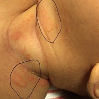 求助！各位宝妈们，宝宝脖子一圈都长了这个，请问有相同情况的宝妈吗，这是怎么了，抹什么能好啊