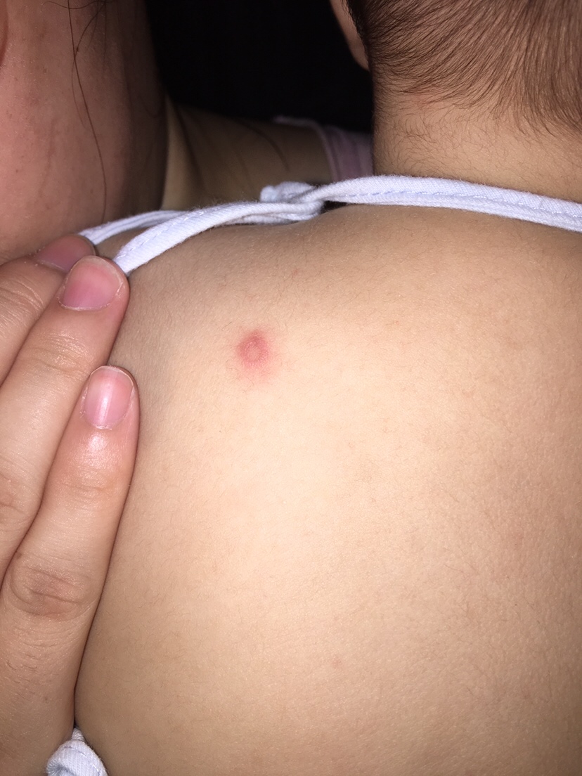 最近洗澡发现宝宝后背长了红点不知道是什么，有知道的吗？