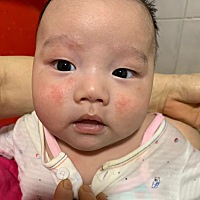 有宝妈知道宝宝脸上这个是什么吗 一直反反复复 觉得宝宝也很难受