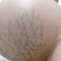 妊娠纹这么这么厉害怎么办啊，自己看着都没有兴趣了，胸部，屁股上全部爬满了，咋办啊，看着都想哭