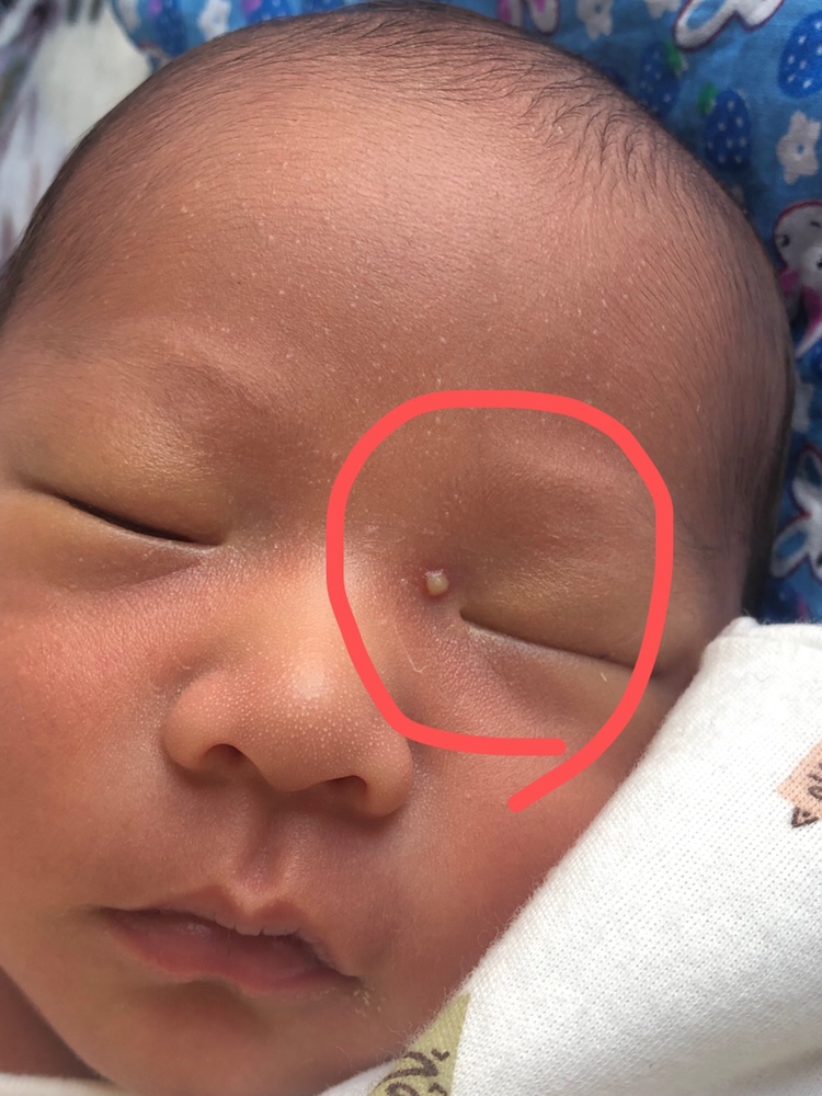 宝宝眼睛旁边起了好大的疙瘩 还有白脓 是上火了？怎么办呢？