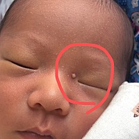 宝宝眼睛旁边起了好大的疙瘩 还有白脓 是上火了？怎么办呢？