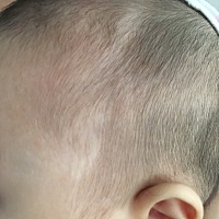 六个月宝宝头皮白了一块，现在又多了一块，大家有知道这是怎么回事吗？区里的医生看不出来没设备。白的...