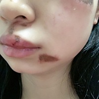 孕妈们一定尽量不要一个人出门，昨下午我就是突然晕倒，脸摔的稀烂，幸好宝宝没什么事情，希望一切...