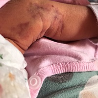 各位宝妈们，你们有没有遇到这种情况，宝宝出生后腿上有一大块红斑，医生也看了，说是让先观察到，...