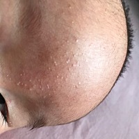 宝宝这个脂肪的疹子 为什么看不好  希望有经验的宝妈帮帮我