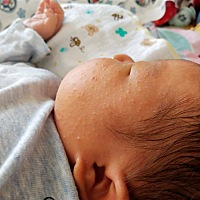 宝宝28天 脸上这是起的什么 是痱子么